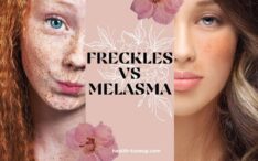 Freckles vs melasma