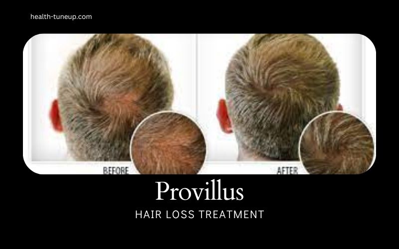 Provillus hair loss treatment reviews before and after
