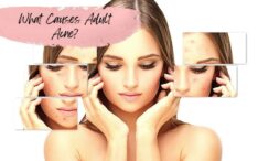 What causes sudden acne on face in adults