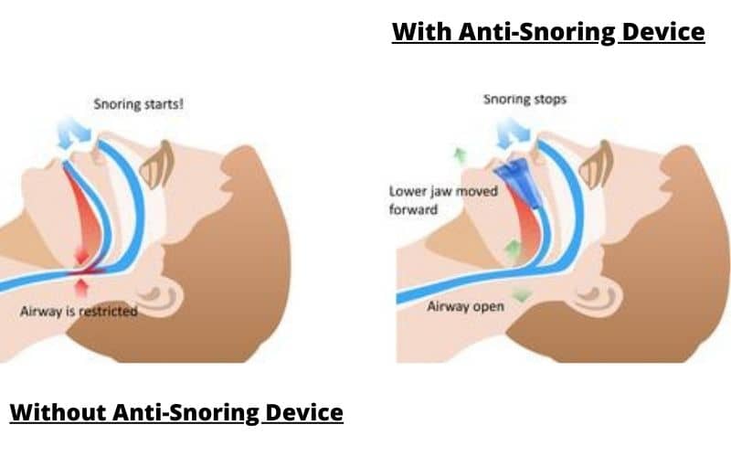 How can an anti-Snoring device help