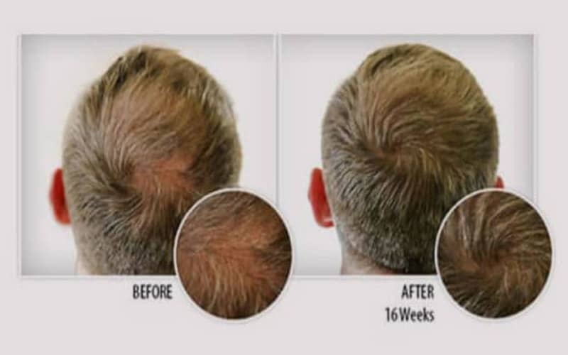 provillus hair loss treatment reviews 