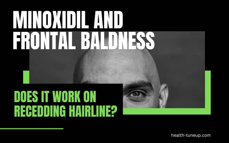 Does Minoxidil Work on Frontal Baldness