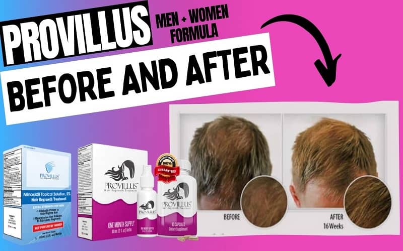 Provillus Hair Loss Treatment Reviews Before And After Pics 6687