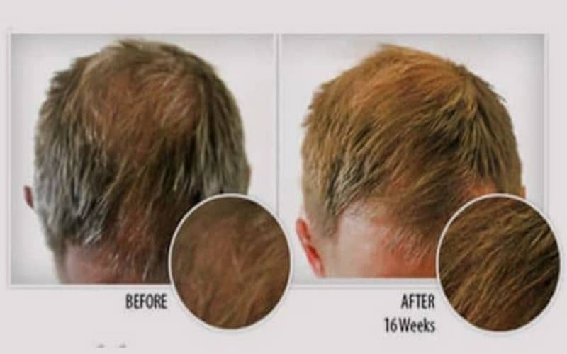 provillus hair loss treatment before and after results reviews