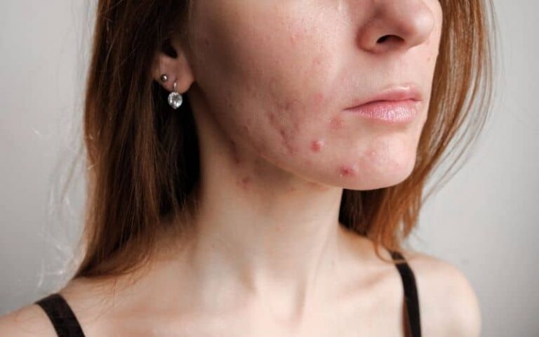 what-causes-sudden-acne-breakout-on-face-in-adults